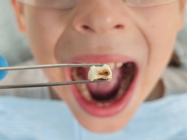 Best Emergency Treatment for Toothache in Deridder, LA